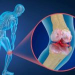 عوامل پوکی استخوان زودتر از ۵۰ سالگی بروز می کند